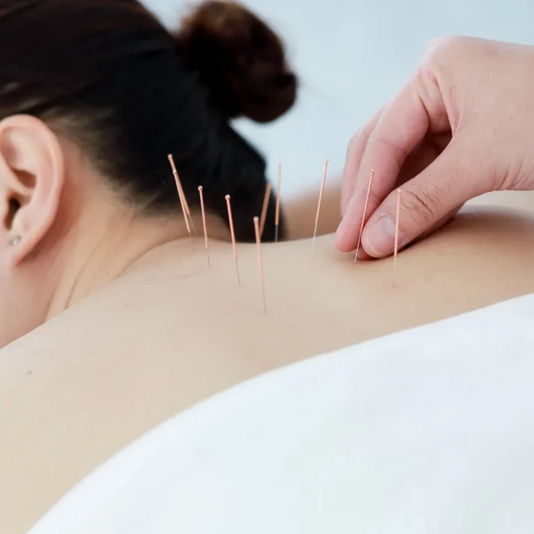 דיקור מערבי (Dry Needling) - טיפול מתקדם לכאבי שרירים