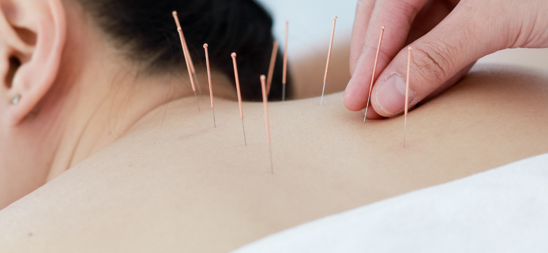 דיקור מערבי (Dry Needling) – טיפול מתקדם לכאבי שרירים